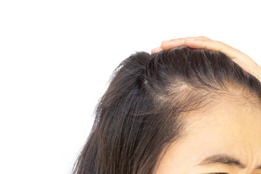 hair loss